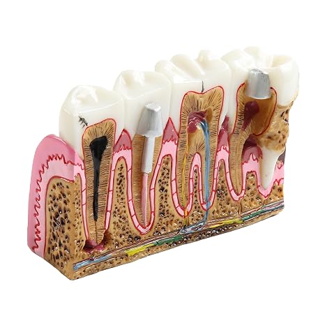 Dental Caries Tooth Anatomy Model Tooth Pathology Models